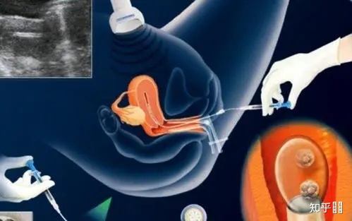 2022-世界艾滋病日｜HIV感染者可以做借卵供卵试管公立吗？
